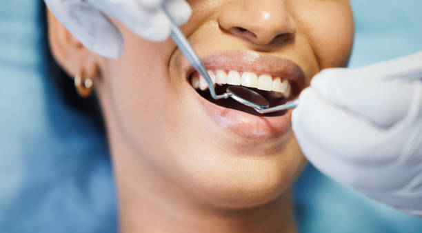 Best Emergency Wisdom Tooth Extraction in Tokeneke, CT